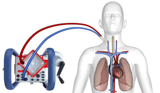 extracorporeal membrane oxygenation (ecmo) in adults